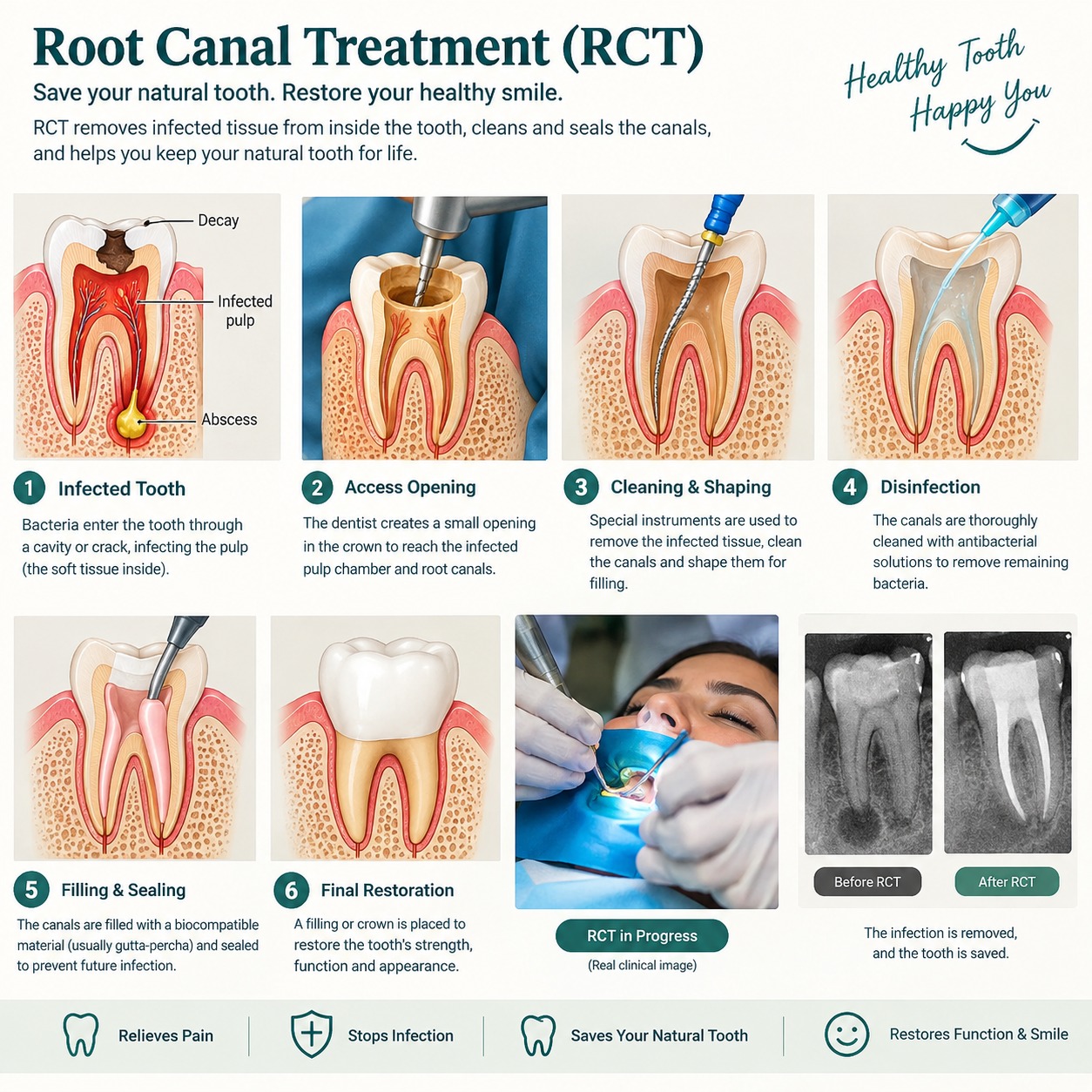 Root Canal Treatment Process
